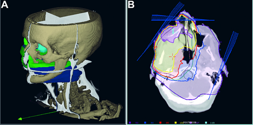 Planejamento radioterapêutico para tratamento de tumor de seio maxilar baseado em imagem de tomografia computadorizada. À esquerda, reconstrução em 3D do tumor que atinge parte do osso da face. À direita, linhas coloridas mostram as áreas que serão irradiadas