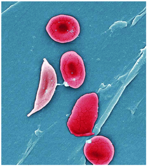 Microfotografia de uma sequncia de hemcias normais ( direita) e de uma hemcia falciforme com formato de foice ( esquerda)